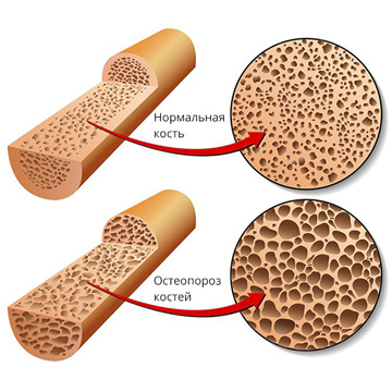 Остеопороз — диагностика и мониторинг лечения